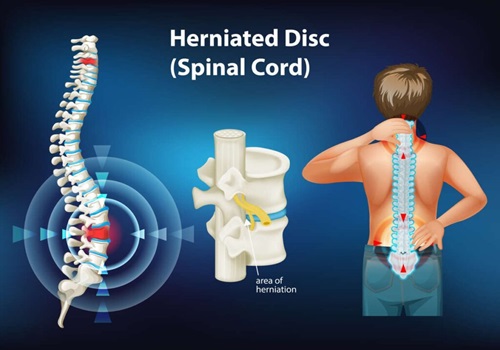 herniated disc