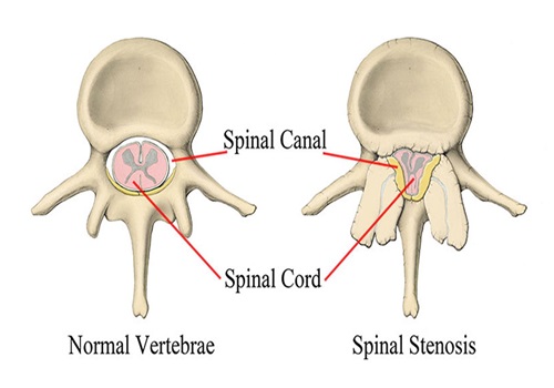 back pain